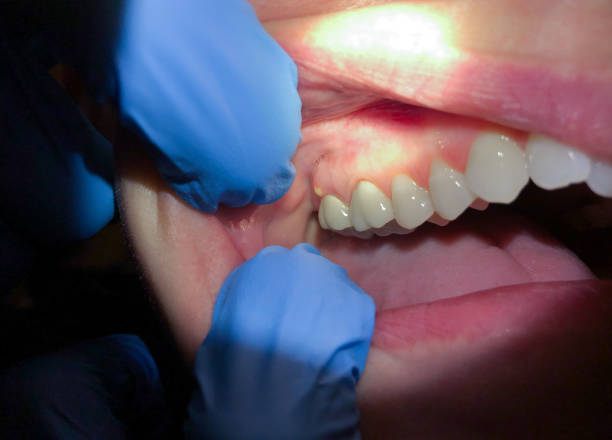 Best Knocked-Out Tooth Emergency  in San Antonio, TX